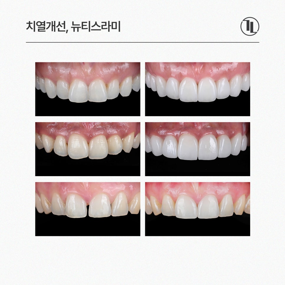 뻐드러진 나비앞니, 시술 전 스마일 시뮬레이션 후 뉴티스라미 관련 이미지 5