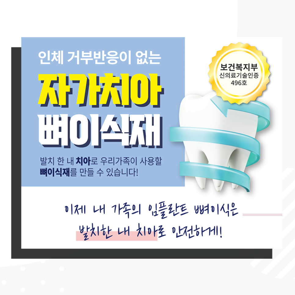 자가치아골이식술, 임플란트 할 때 내 이로 만든 뼈 사용!! 관련 이미지 1