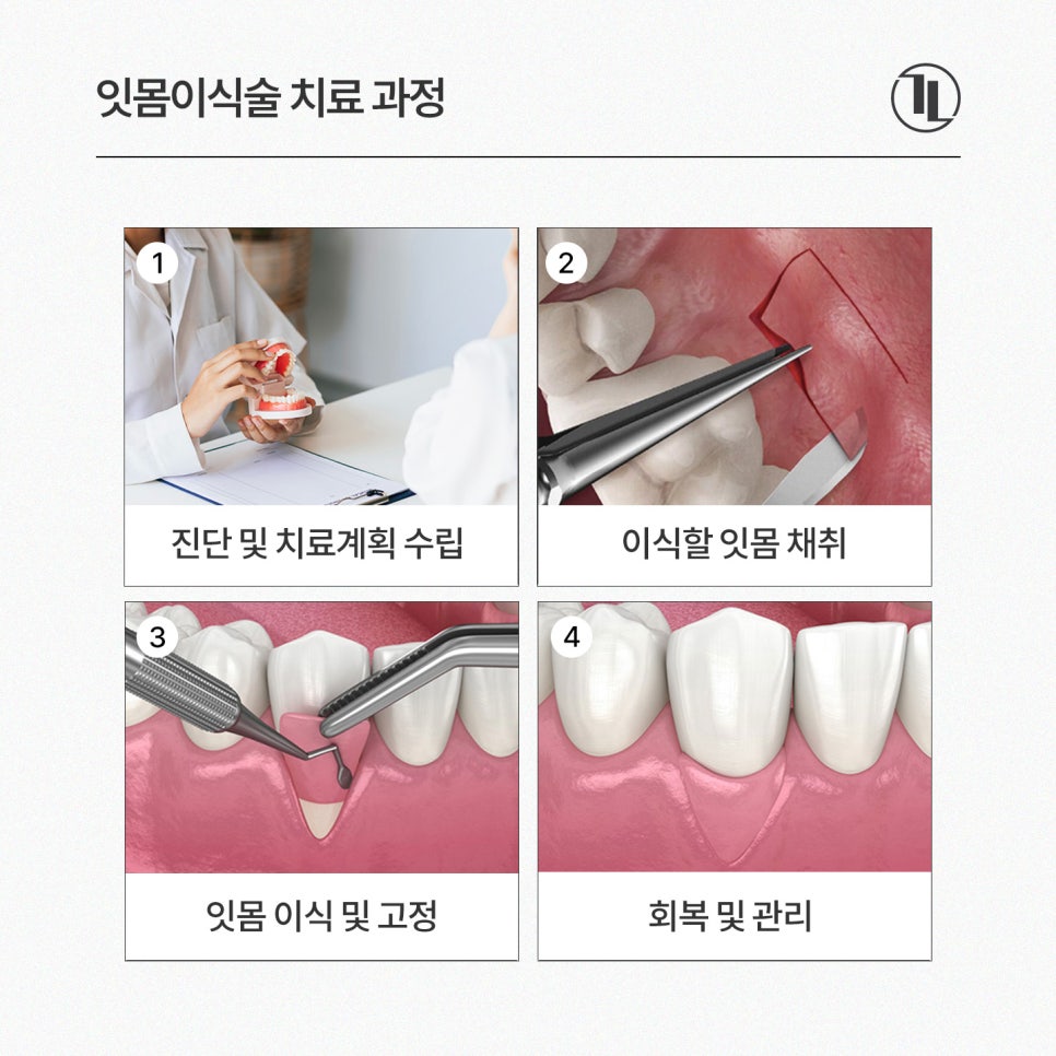 Receding Gums and Tooth Sensitivity, Gum Recession / A Complete Guide from Causes to Treatment / Gangnam Leon Dental Clinic image 6