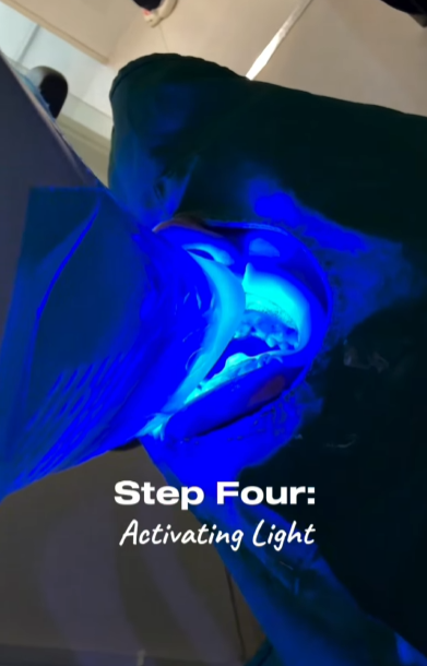 강남레옹치과 뉴티스 치아미백 Vlog📽️ | 치아미백 효과, 유지기간, 부작용 총정리! 관련 이미지 10