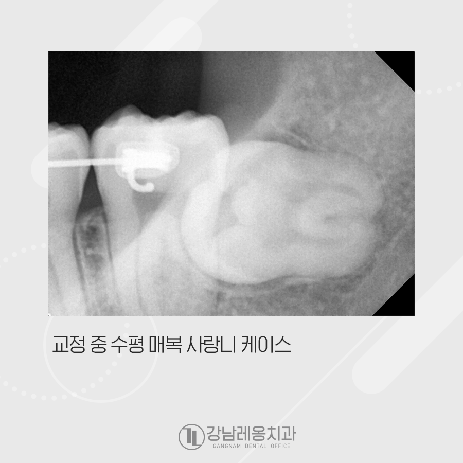교정 중 수평매복사랑니 발치, 강남레옹치과에서 관련 이미지 3