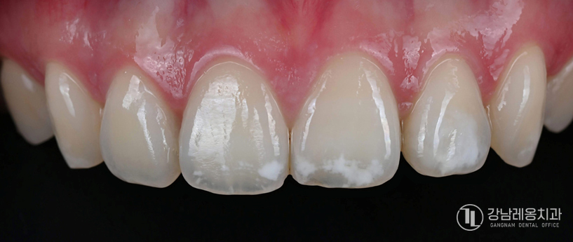 앞니 끝이 살짝 깨졌다면? 뉴티스 치아성형으로 자연스럽게 치아라인 정리하기 관련 이미지 6