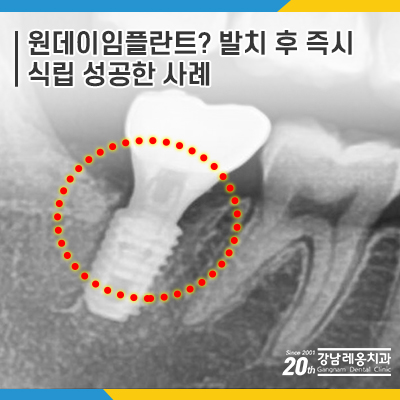 강남레옹치과 원데이 임플란트, 발치 즉시 식립까지 완료 관련 이미지 5