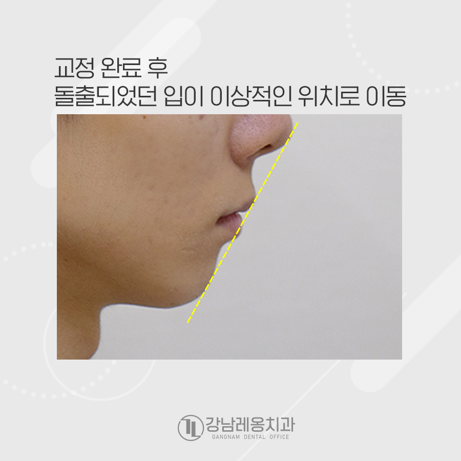 앞니 뻐드러짐 치아 교정으로 돌출입 들어간 케이스 관련 이미지 4