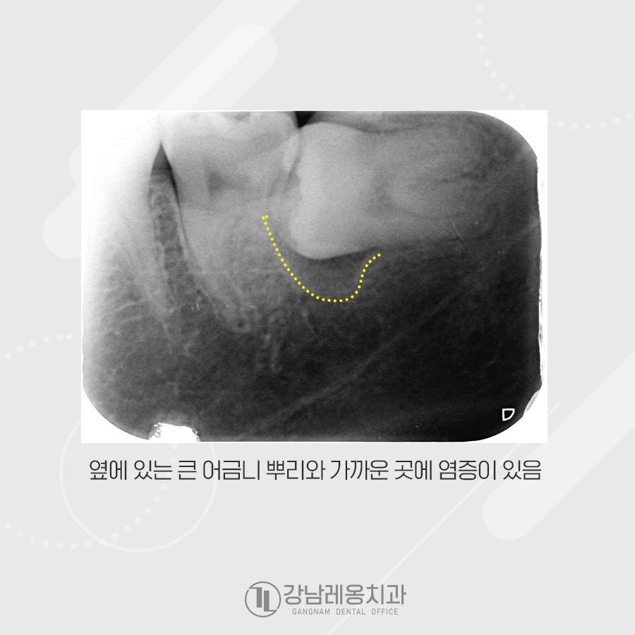 누운 사랑니 발치, 신경관과 겹쳐있는데 강남레옹치과에서 가능한가요? 관련 이미지 3