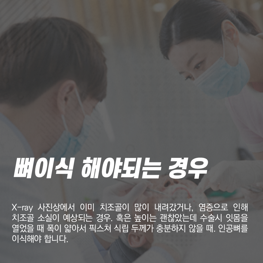 강남레옹치과 뼈이식 임플란트 수술, 어떤 경우에 해야 될까? 관련 이미지 3