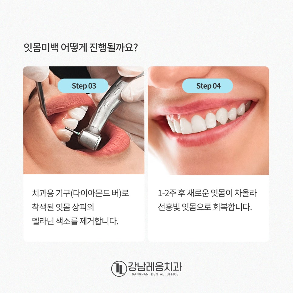 잇몸도 화이트닝이 된다? 까만 잇몸, 착색 잇몸 미백 / 강남레옹치과 관련 이미지 4