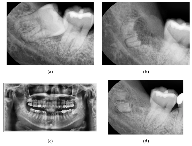 공부하는 강남레옹치과, 사랑니 치관절제술에 관한 논문 참여 관련 이미지 5
