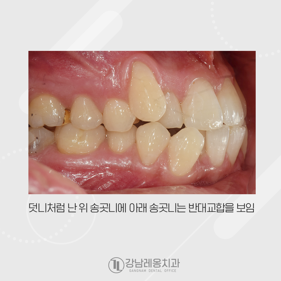 발치 치아교정, 덧니 총생 반대교합까지 한번에 해결 관련 이미지 2