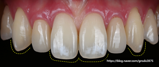 앞니에 하얀얼룩이? 앞니 길이가 달라요! / 앞니통합치료 뉴티스 반점치료 + 치아성형✨ / 강남레옹치과 관련 이미지 6