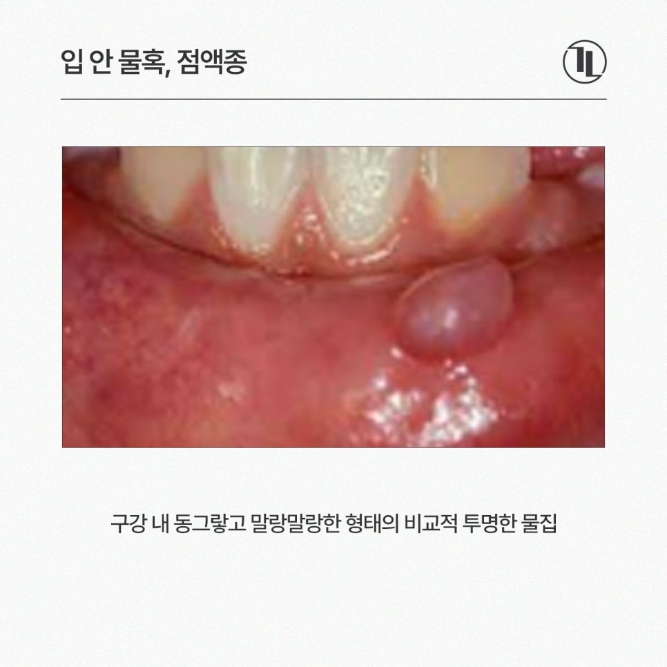 입안 피물집, 물혹, 혓바늘, 혀돌기(유두종) 원인 및 치료 / 강남레옹치과 관련 이미지 3