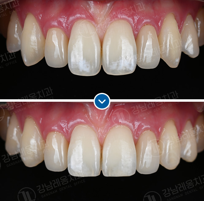 박영민 원장님의 뉴티스 앞니치료 세미나 in LA🤓 관련 이미지 5