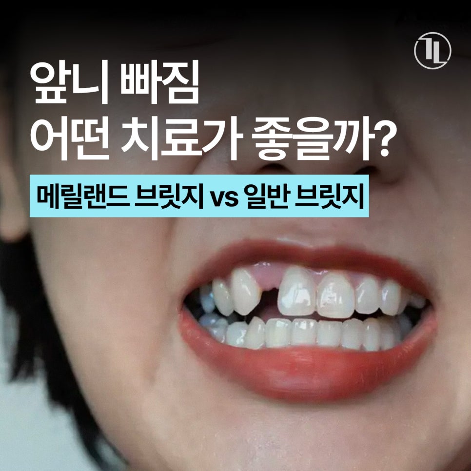 Lost a Front Tooth? Comparing Maryland Bridges, Traditional Bridges, and Implants / Gangnam Leon Dental Clinic image 1
