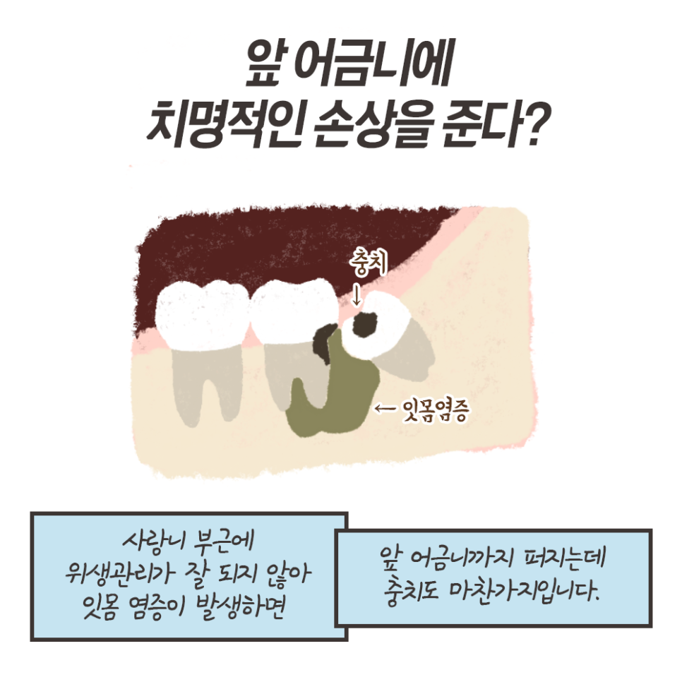 사랑니 발치 이유!! 최악의 경우 이렇게까지 된다..? (냐폴레옹툰 7화) 관련 이미지 8