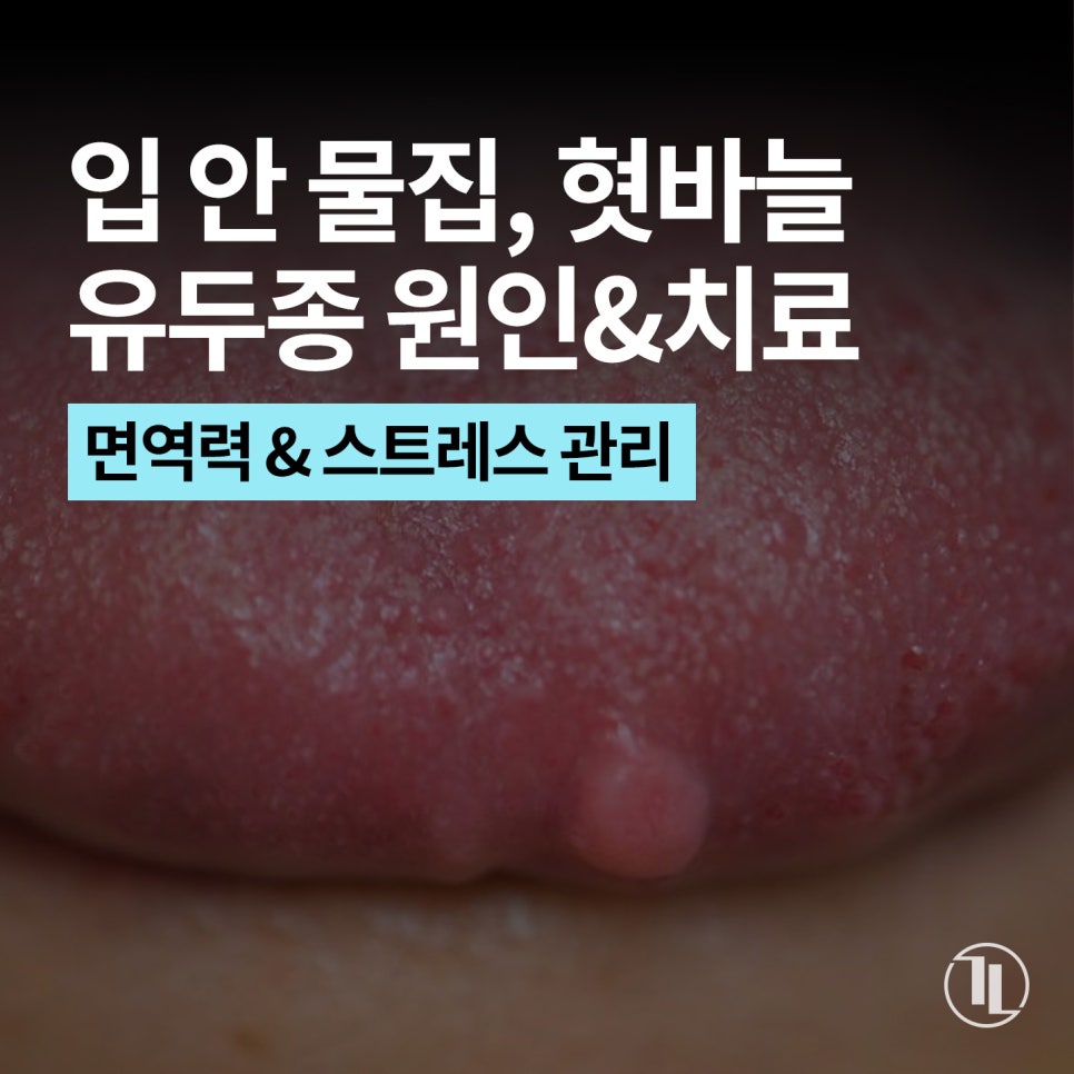 입안 피물집, 물혹, 혓바늘, 혀돌기(유두종) 원인 및 치료 / 강남레옹치과 관련 이미지 1