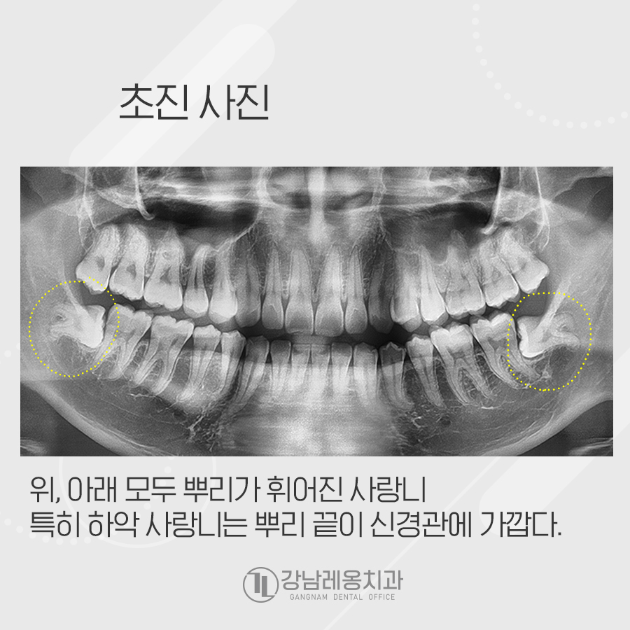 만곡치근? 뿌리가 휜 사랑니 4개 뽑아드린 발치 케이스 관련 이미지 2