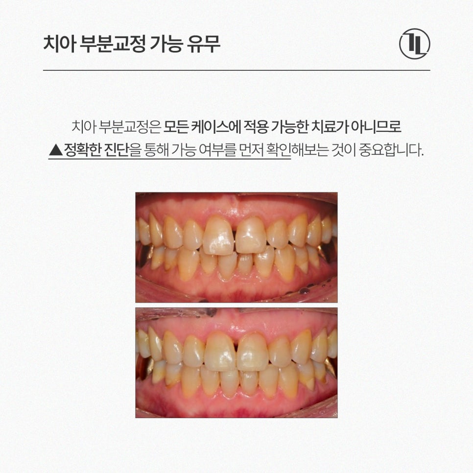 앞니 부분교정 가능여부와 기간 현실 정리! / 강남레옹치과 관련 이미지 3