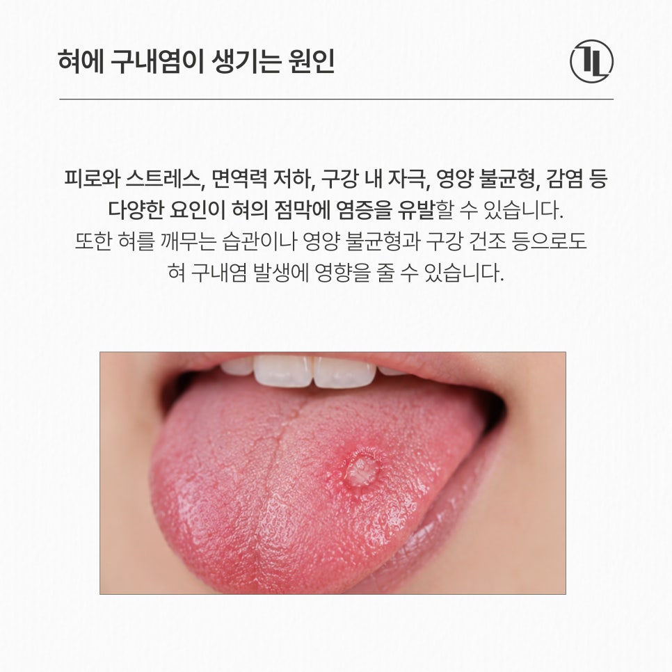혀에 자꾸 구내염이 생긴다면? 원인부터 치료 관리법까지 / 강남레옹치과 관련 이미지 2