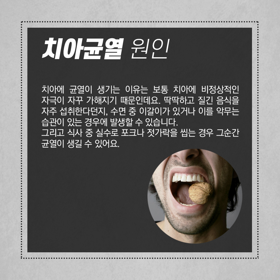 금이 간 치아, 균열이 생겼을 때 대처법! 관련 이미지 3