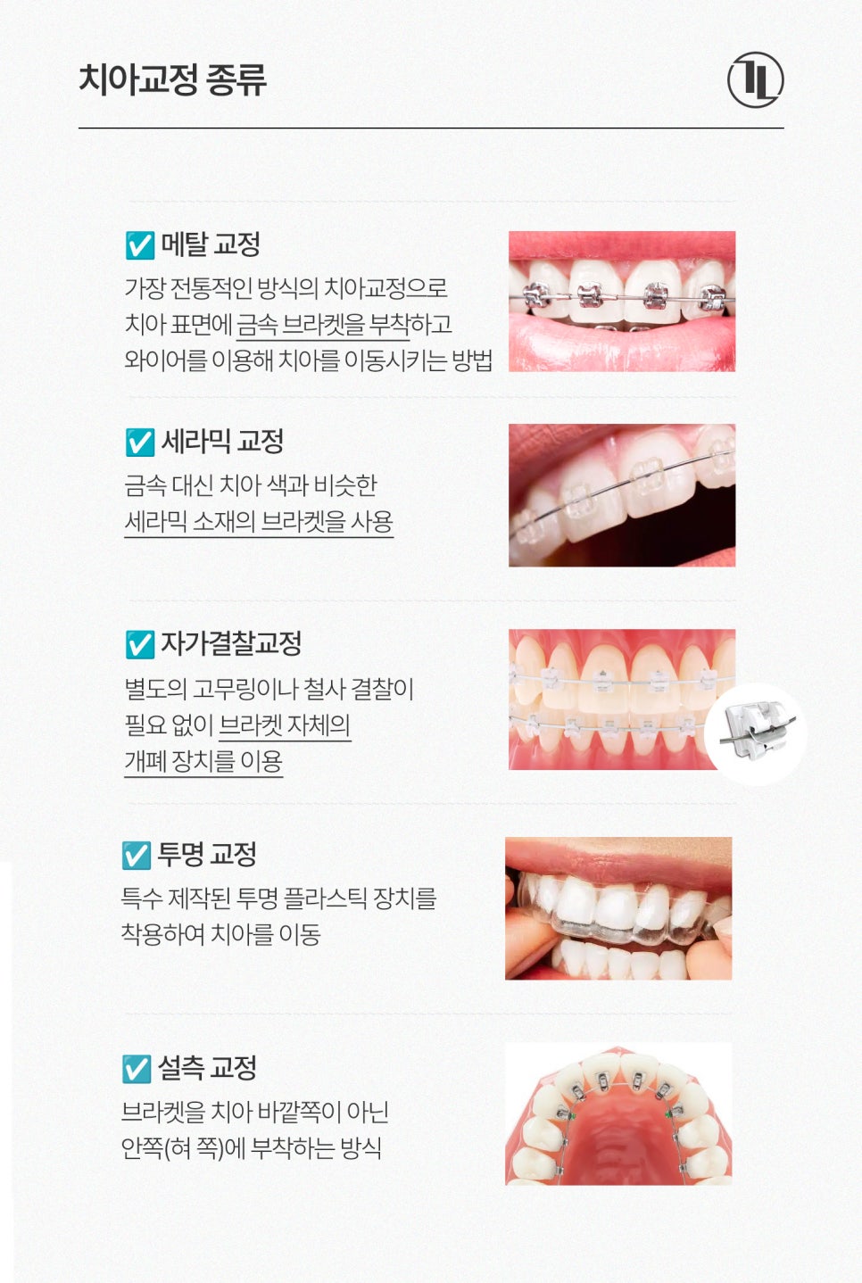 치아교정 현실 가이드 / 치아교정 종류, 비용, 기간,  FAQ까지 / 강남레옹치과 관련 이미지 3
