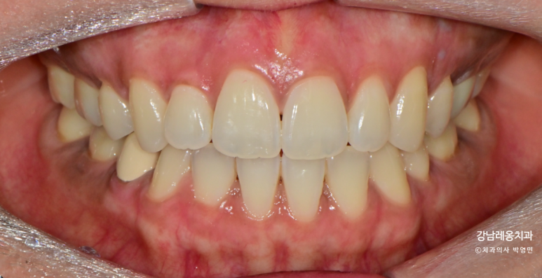 잇몸도 화이트닝이 된다? 까만 잇몸, 착색 잇몸 미백 / 강남레옹치과 관련 이미지 8