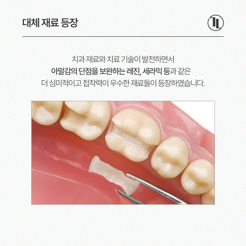 Should You Replace Dental Amalgam? Reasons and Necessity for Amalgam Replacement / Gangnam Leong Dental Clinic image 3