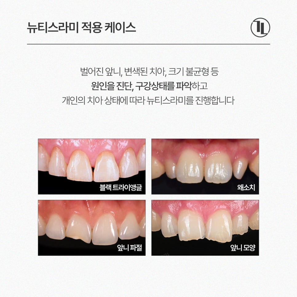 앞니 벌어짐, 정중이개 뉴티스라미 / 강남레옹치과 뉴티스 스마일 시뮬레이션 관련 이미지 3