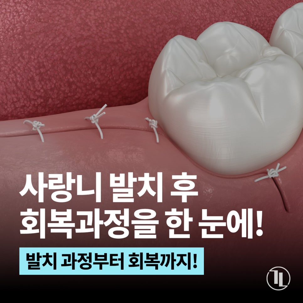 사랑니 발치 후 회복과정 한 눈에 보기🔍 / 강남역 사랑니 강남레옹치과 관련 이미지 1