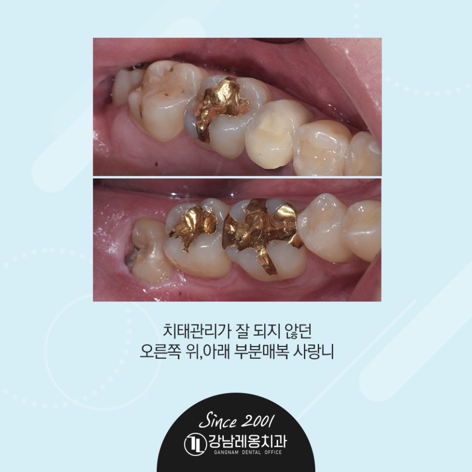 강남레옹치과 사랑니 발치! 통증 붓기 없이 2개를 한번에 뽑은 사례 관련 이미지 2