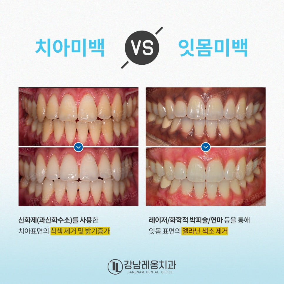 잇몸미백 효과 있나요? 시술 전후와 유지기간, 부작용까지!  / 강남레옹치과 뉴티스 잇몸미백 관련 이미지 3
