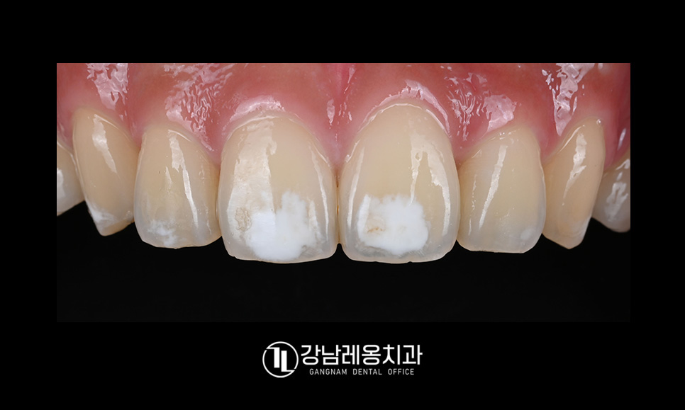 앞니 하얀점, 앞니 반점치 삭제없이 치료! / 아이콘 레진 치료 / 강남레옹치과 관련 이미지 2
