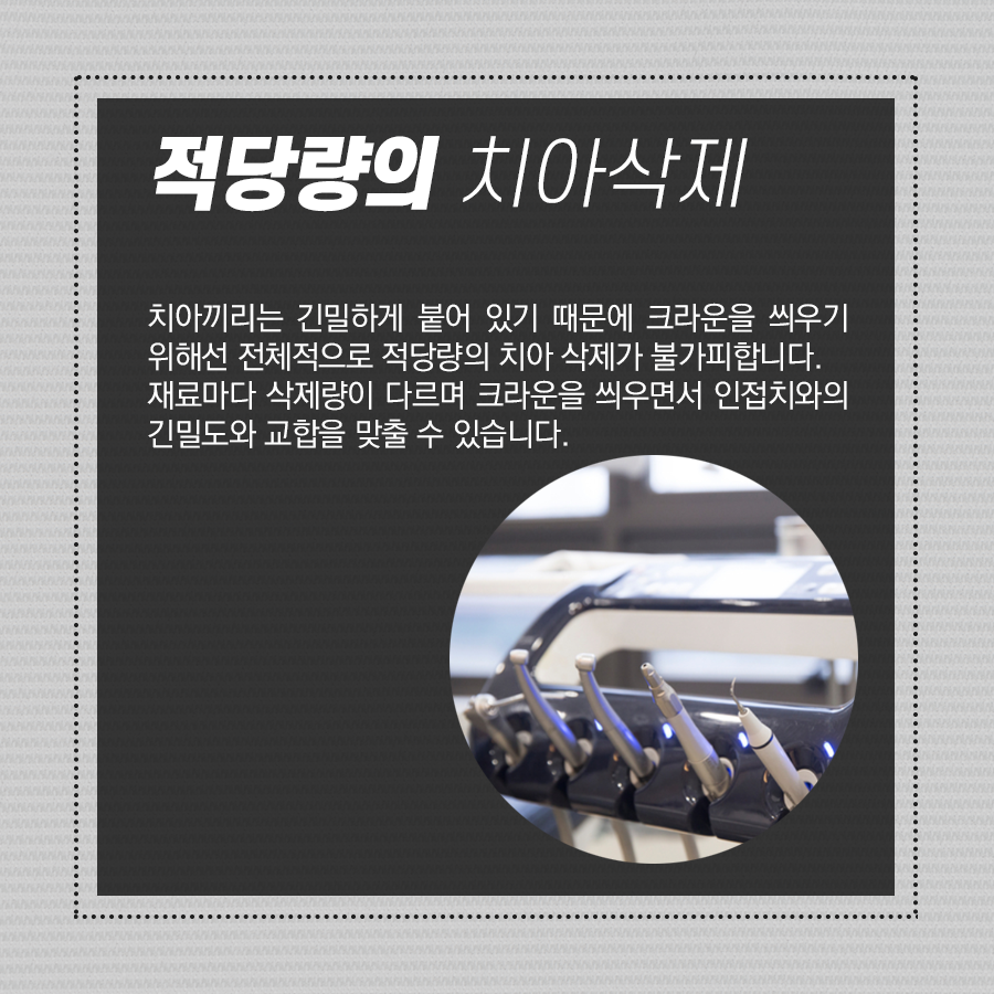 치아 크라운 과정, 어떤 순서로 진행이 될까? 관련 이미지 3