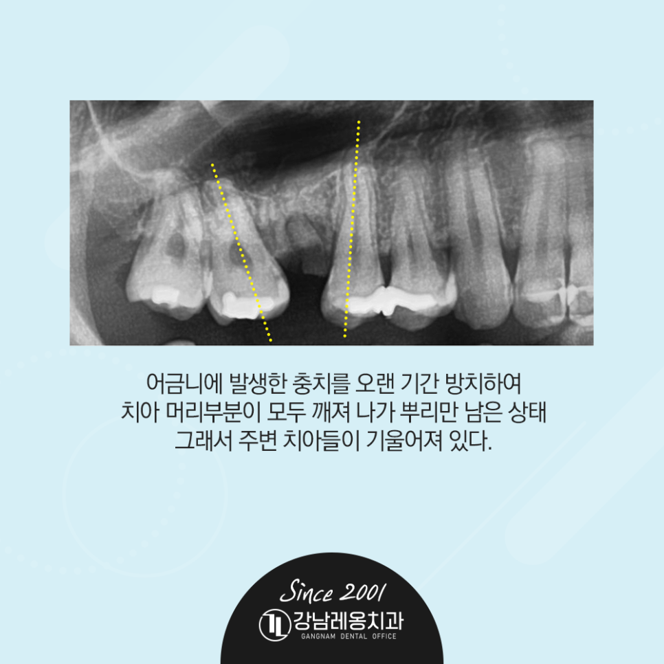 옆 치아 쓰러져 좁아진 공간, 강남레옹치과 임플란트 수술 증례 관련 이미지 2
