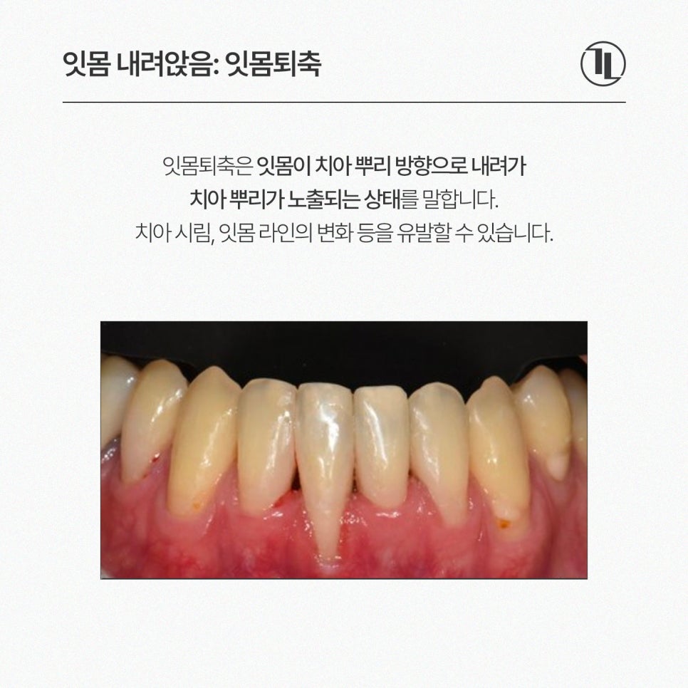 Receding Gums and Tooth Sensitivity, Gum Recession / A Complete Guide from Causes to Treatment / Gangnam Leon Dental Clinic image 2
