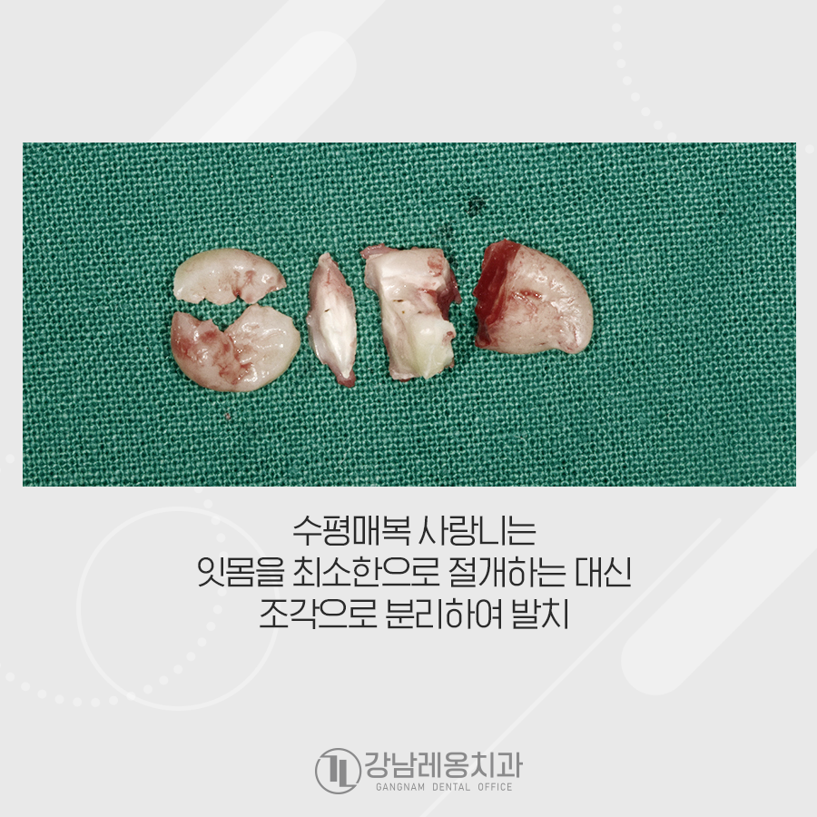 누운 사랑니 전문 치과! 수평 매복 분리해서 빠르게 발치~! 관련 이미지 2