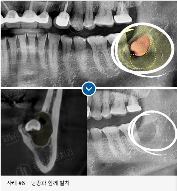 사랑니 발치, 왜 어떤 경우에 대학병원을 권유할까? / 강남레옹치과 관련 이미지 14