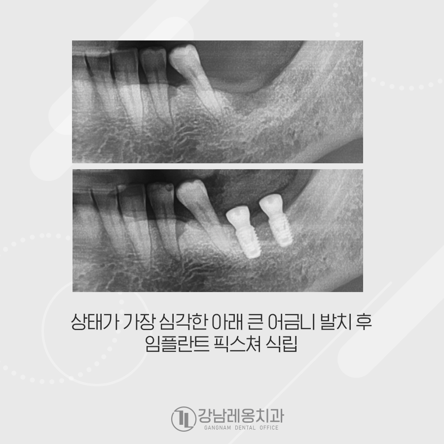 잇몸 염증 때문에 치조골 흡수, 발치 후 임플란트 수술 관련 이미지 3