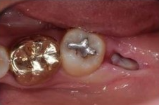 사랑니 발치 후 회복과정 한 눈에 보기🔍 / 강남역 사랑니 강남레옹치과 관련 이미지 9