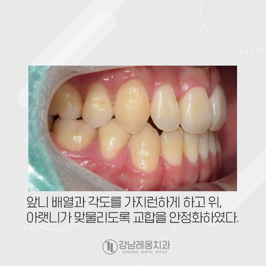 앞니가 물리지 않는 개방교합과 주걱턱을 치아교정으로 한번에..? 관련 이미지 4