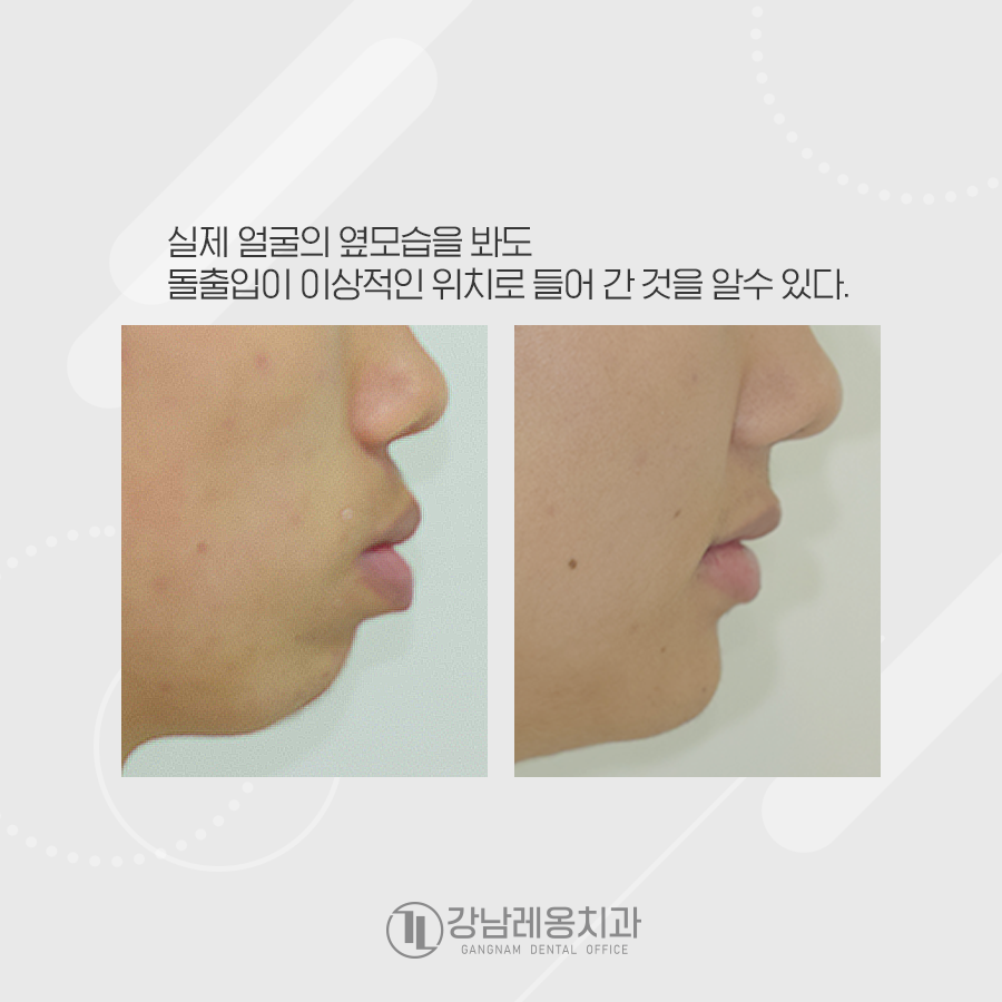 돌출입, 치아교정으로 심미라인에 맞춰 예쁘게 완성 관련 이미지 3
