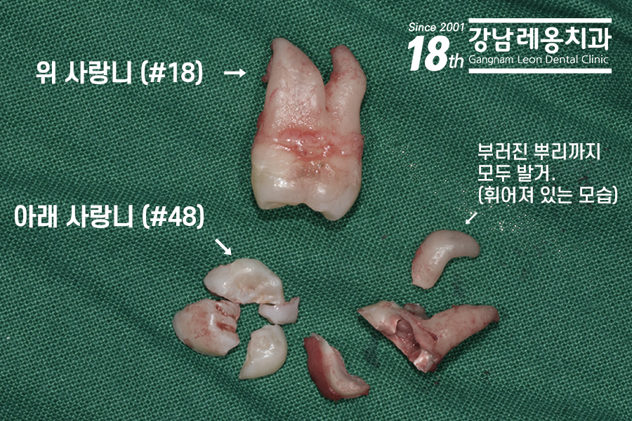 강남 레옹치과 뿌리 휘어진 사랑니 발치, 2개 한꺼번에 뽑은 사례 관련 이미지 4
