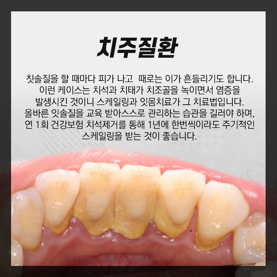 잇몸 부었을 때, 그 질환 원인과 치료법은 무엇일까요?? 관련 이미지 4
