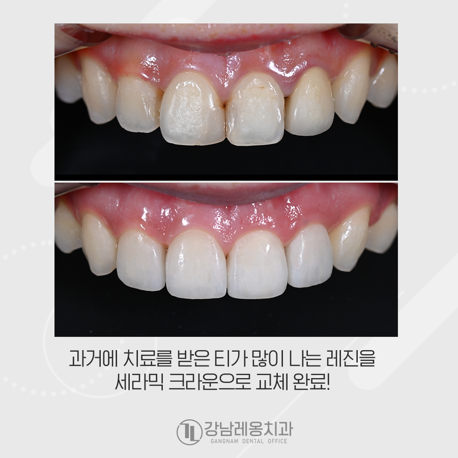 오래된 레진 교체 앞니 크라운! 강남레옹치과의 오랄디자인으로 개선 관련 이미지 3
