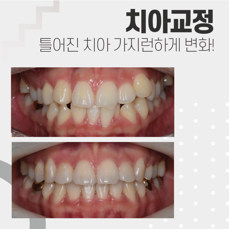 치아총생 덧니를 가지런하게 교정~! 관련 이미지 1