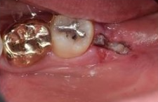 사랑니 발치 후 회복과정 한 눈에 보기🔍 / 강남역 사랑니 강남레옹치과 관련 이미지 6