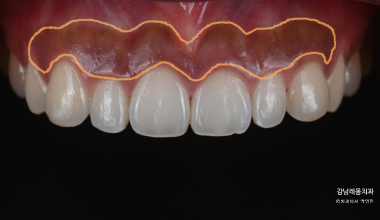 Concerned About Dark Gums Showing When You Smile? Gum Whitening Procedure Effects, Duration, and Precautions! / Gangnam Leong Dental New-Teeth Gum Whitening image 2