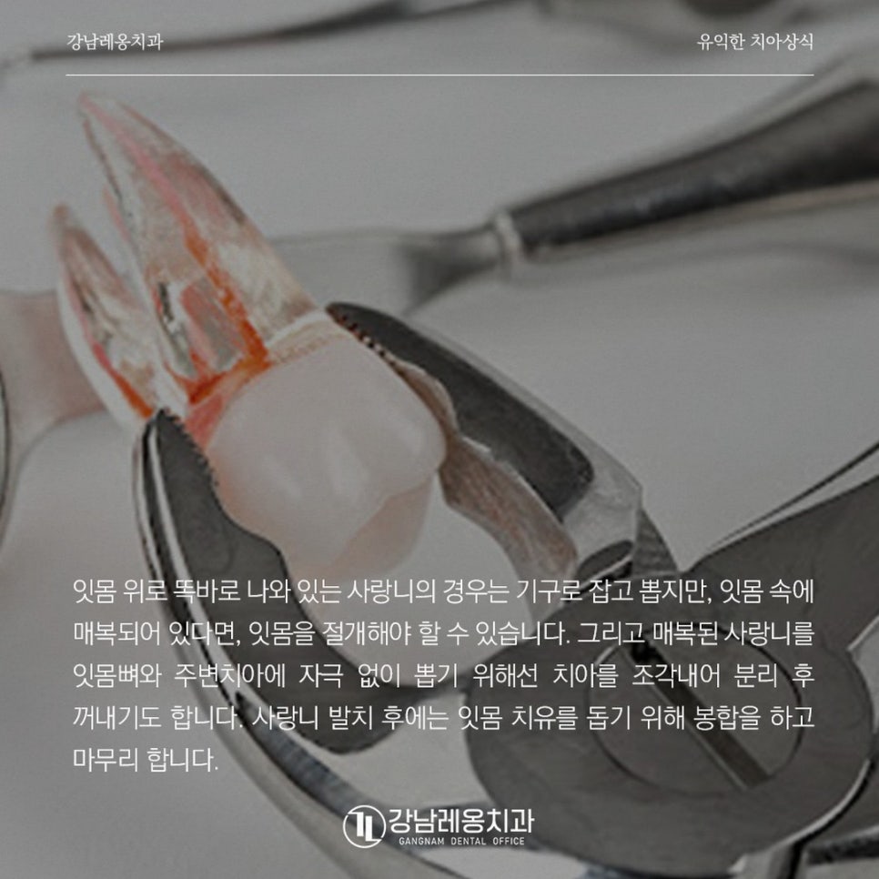 강남레옹치과에서 알려드리는  매복된 사랑니 발치과정에 대해 알아보기! 관련 이미지 5