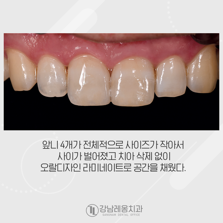 앞니 벌어짐 무삭제 라미네이트 치료는 장단점 꼭 확인! 관련 이미지 5