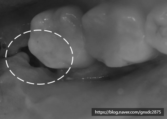 사랑니 발치 후 구멍, 음식물 끼임부터 회복, 관리법까지 총정리📑 / 강남레옹치과 관련 이미지 2