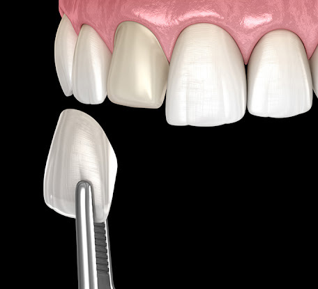 찬물 이시림 증상 원인과 치료, 시린 치아 관리 가이드🔖 / 강남레옹치과 관련 이미지 5